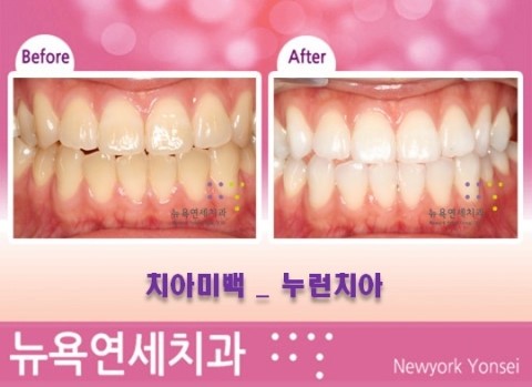  강남역치과 치아미백 전문