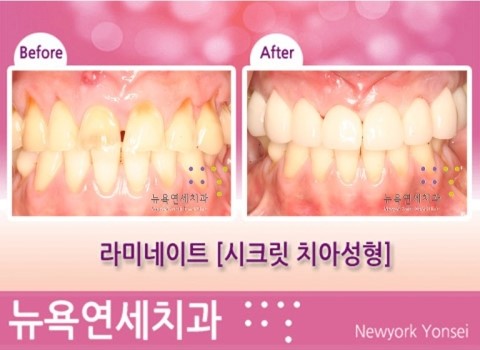  강남역치과 치아성형 * 라미네이트 잘하는곳