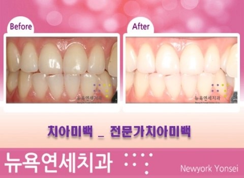  [강남역치과] 치아미백 정보