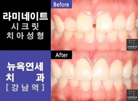  [뉴욕연세치과 Q&A] 벌어진치아 라미네이트 치아성형