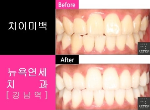  치아미백 치아미백잘하는곳*원데이치아미백