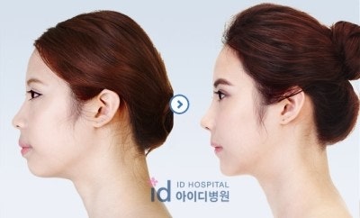 돌출입수술 비용 알려줄께