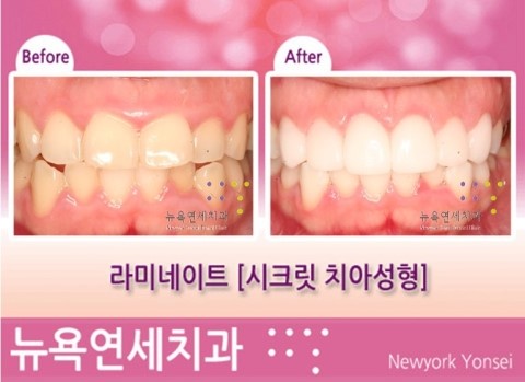  [강남역치과] 앞니 라미네이트