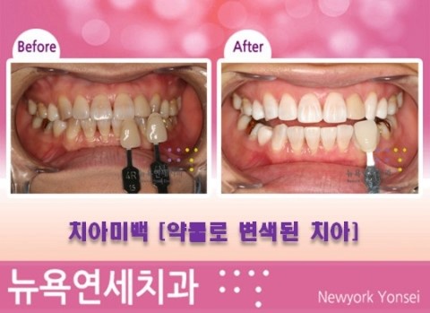 [강남역 치아미백 치과] 치아미백 시술전후