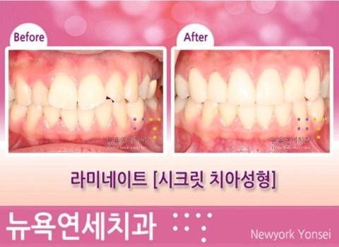  라미네이트가격 라미네이트비용