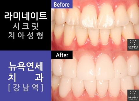  치아성형 라미네이트*치아성형