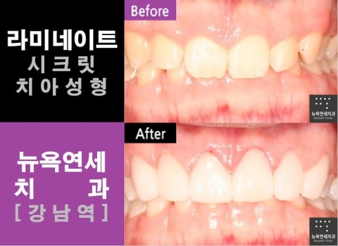  치아성형'치아성형(라미네이트/올세라믹)'