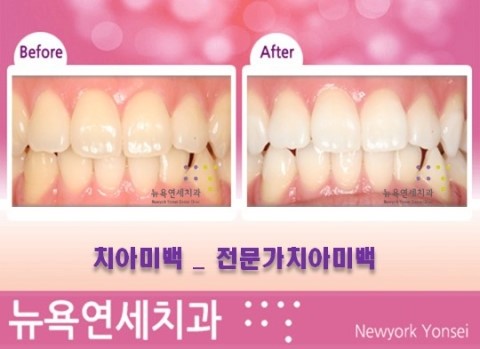  치아미백 추천대상