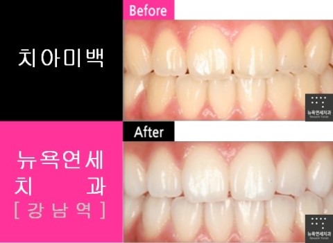  치아미백 가격 & 비용
