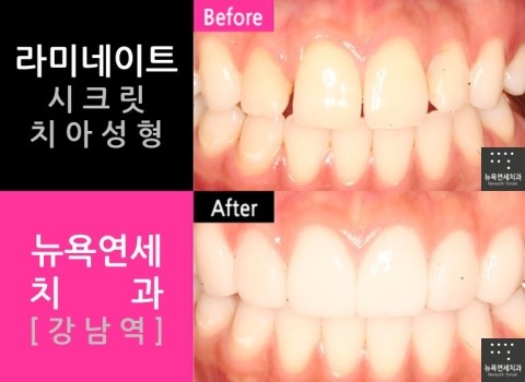  [뉴욕연세치과 치아성형 Q&A] 치아성형 부작용과 치아성형시 내원 횟수