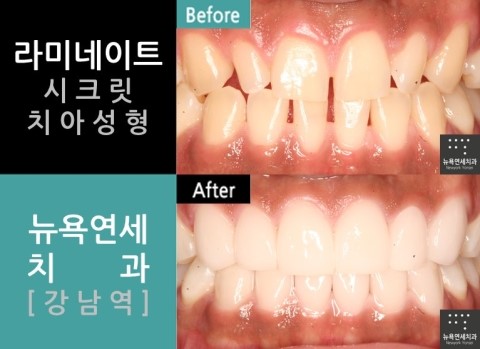  라미네이트 치과