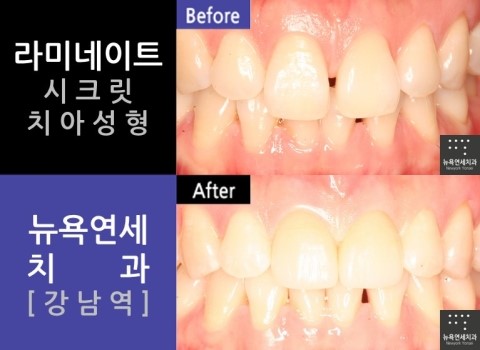  [강남역치과] 라미네이트전문치과