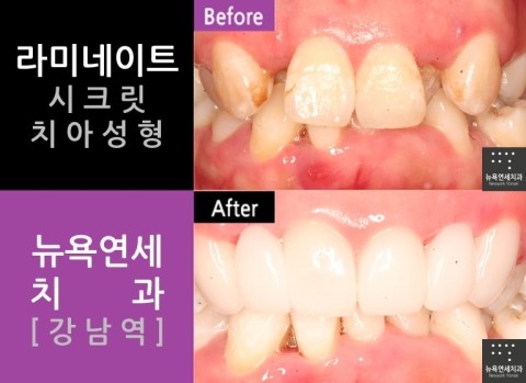  치아성형'라미네이트