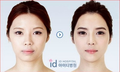 돌출입수술 비용보다 중요한건?
