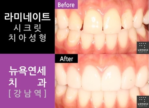  라미네이트 정보!