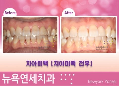  강남역치아미백 [치아미백잘하는곳_뉴욕연세치과] 환한미소 만들기