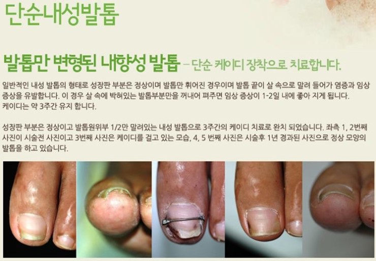 내성발톱 케이디(K-D) 발톱교정시술 :: 수술날 ♩ 당해보지않은자 공감하지 말지어다 : 네이버 블로그 내성발톱 케이디(K-D) 발톱교정시술 :: 수술날 ♩ 당해보지않은자 공감하지 말지어다 : 네이버 블로그