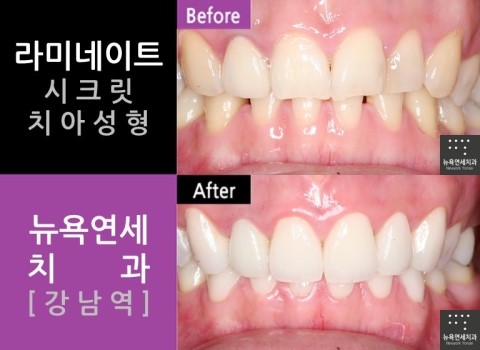  치아성형전문치과, 라미네이트잘하는곳