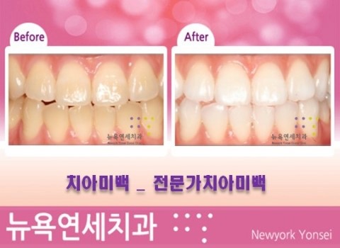  [치아미백 통증 치과전문의 1:1 맞춤 상담] 치아미백 아픈가요?