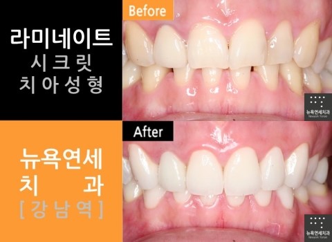  앞니 치아성형