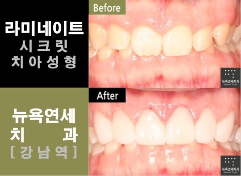  강남 라미네이트 치과