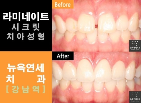  라미네이트 추천대상