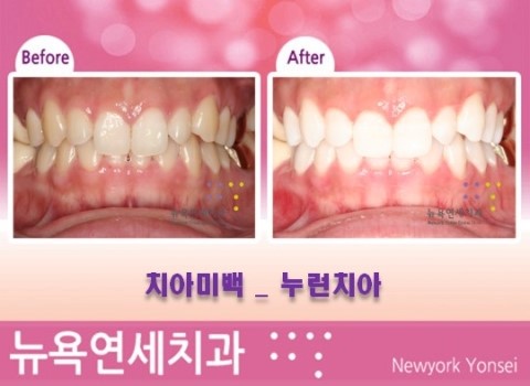  앞니미백 * 치아미백