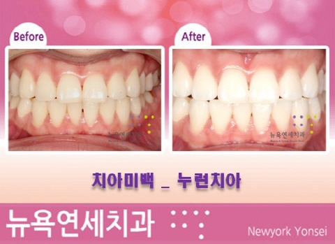  치아미백 * 취업전치아미백