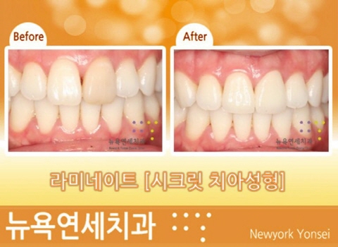  강남뉴욕연세치과 라미네이트이벤트 가격