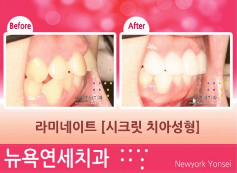  앞니 라미네이트
