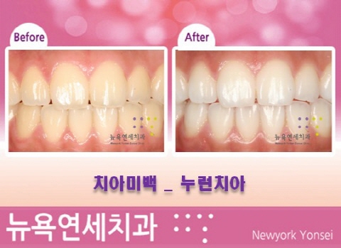  [치아미백 질문] 누런이 치아미백 효과와 치료방법 상담