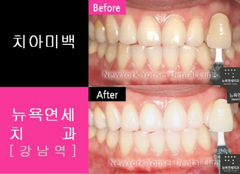  자가 치아미백*전문가 치아미백