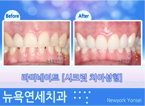 강남역 치아성형 치과
