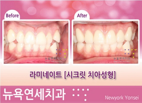  치아성형 가격 & 비용