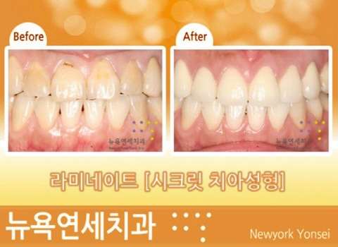  [치아성형 Q&A] 남자 앞니라미네이트 or 앞니치아교정