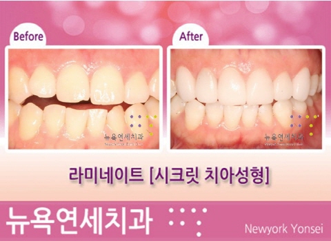  치아성형, 라미네이트잘하는곳