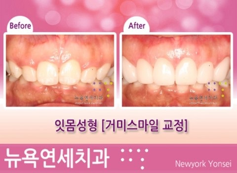  잇몸성형 [뉴욕연세치과 Q&A] 튀어나온 입 잇몸성형으로 해결할 수 있나요?