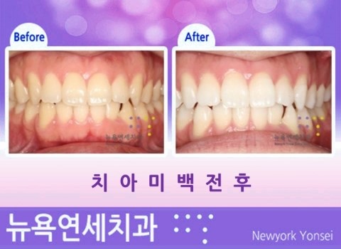 누런이치아착색 치아미백치약 vs 치아미백
