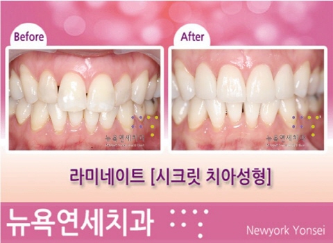  엠프레스 라미네이트