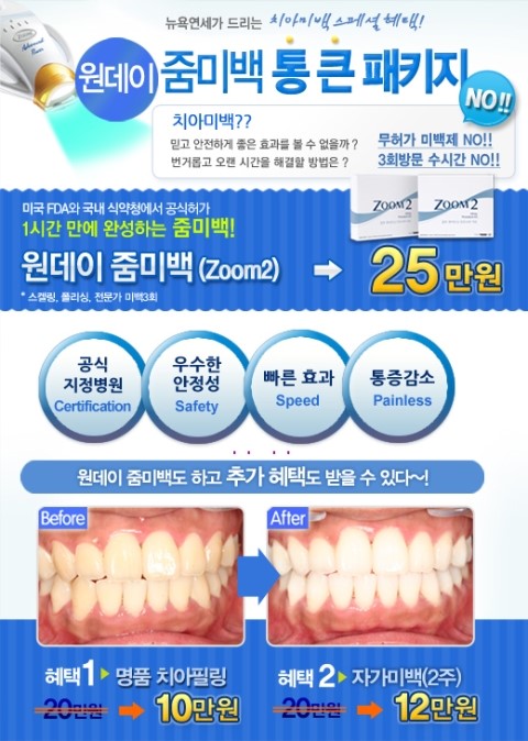  치아미백이벤트가격