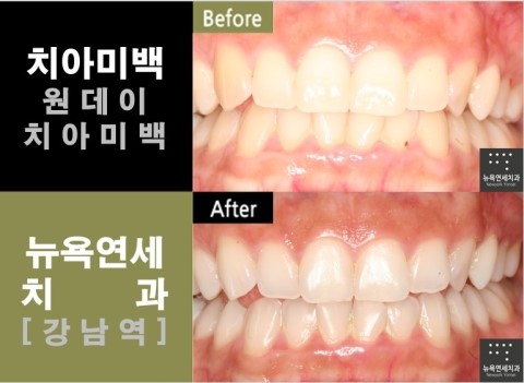 [강남역치과] 치아미백 전문치과 _ 치아미백 전후 사진