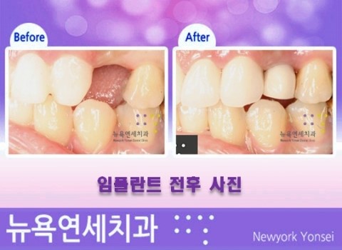  임플란트의 종류