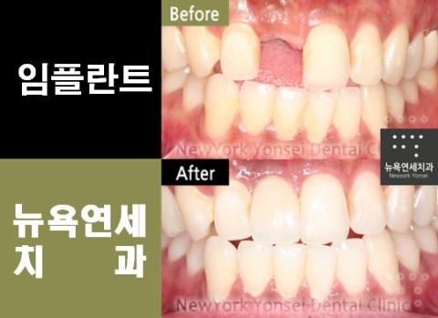  임플란트 가격 & 비용