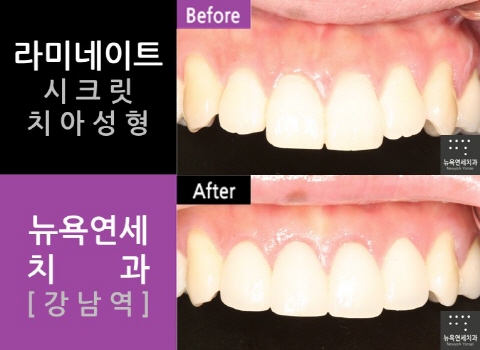  라미네이트잘하는곳 '뉴욕연세치과'