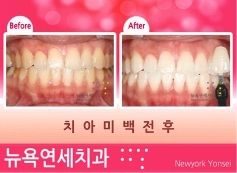  원데이 치아미백가격