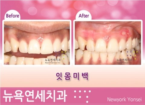  [뉴욕연세치과 잇몸미백 Q&A] 검게 변색된 잇몸