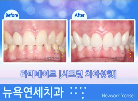  라미네이트 전후 뉴욕연세치과