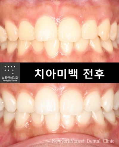 강남역치과 치아미백 잘하는곳