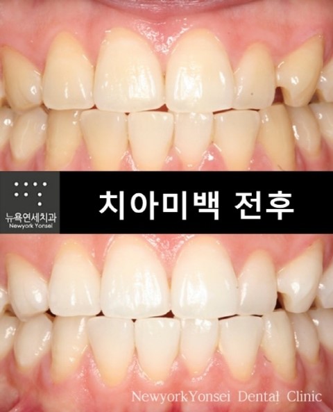  치아미백가격