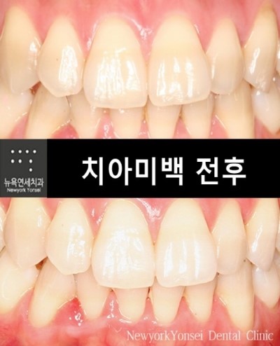[강남역 치아미백 치과] 치아미백 시술전후